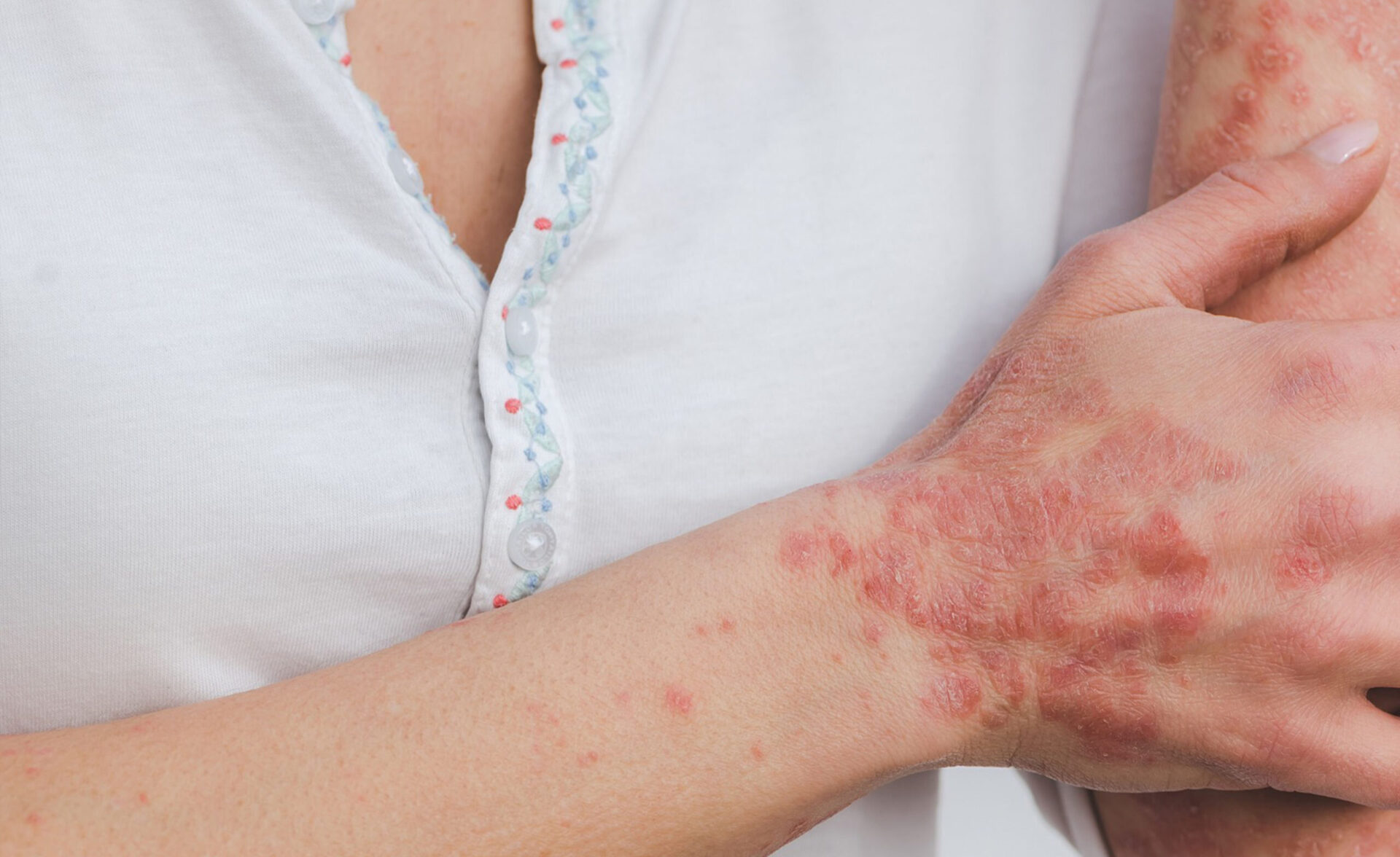 Psoriasis und Dekubitus